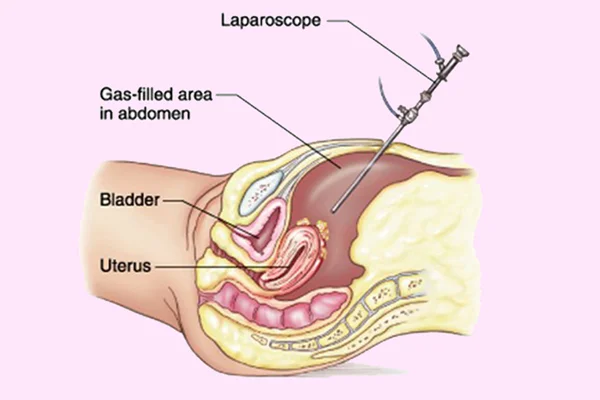 Laparoscopic Hysterectomy