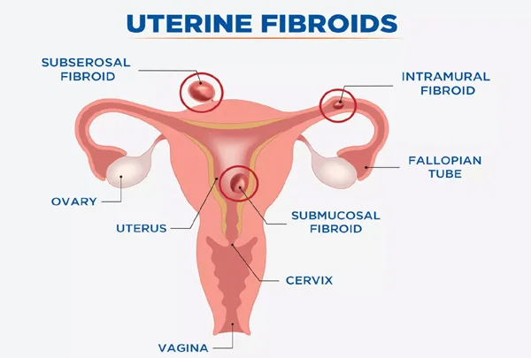 Fibroid Treatment