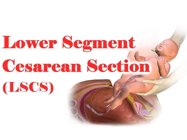 LSCS